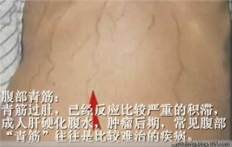 76個(gè)中藥外敷肚臍偏方【非常實(shí)用】 - 民間骨膜修復(fù)專家 - 青島葉氏三位一體正骨揉筋針灸術(shù)