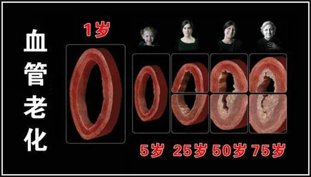 預(yù)防和治療心腦血管病 - 山野村夫 - 自由人.山野村夫 專家:血管老化和去除動(dòng)脈粥樣硬化斑塊的方法 - 逍遙客 - 逍遙客