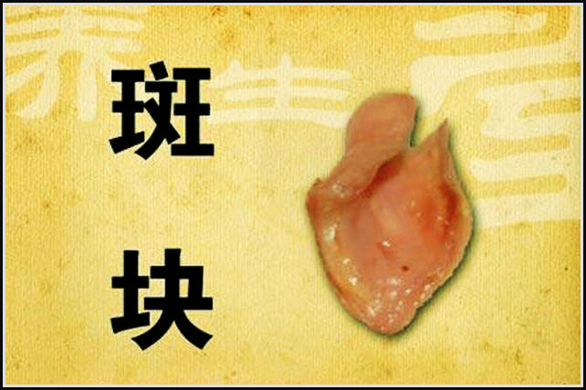 預(yù)防和治療心腦血管病 - 山野村夫 - 自由人.山野村夫 專家:血管老化和去除動(dòng)脈粥樣硬化斑塊的方法 - 逍遙客 - 逍遙客