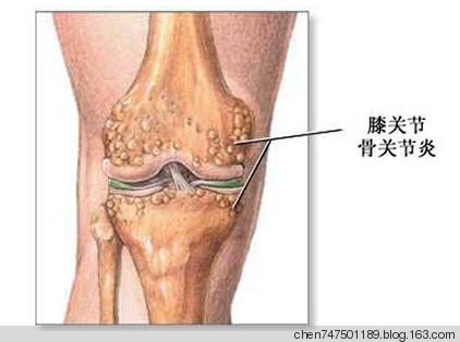 “針刀松解術(shù)”治療骨性關(guān)節(jié)炎 - 真善美 - chen747501189